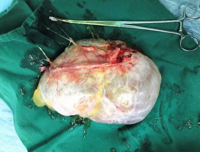 故事六旬阿姨以为身体发福谁知渐渐隆起的腹内竟藏有柚子般大的肿瘤