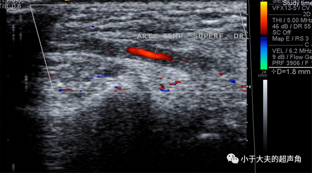 超声随响〗第75期 颞动脉炎和晕环征 halo sign