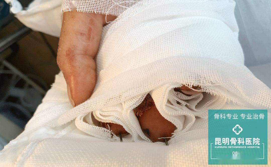 6小时断指再植工人3指成功复活