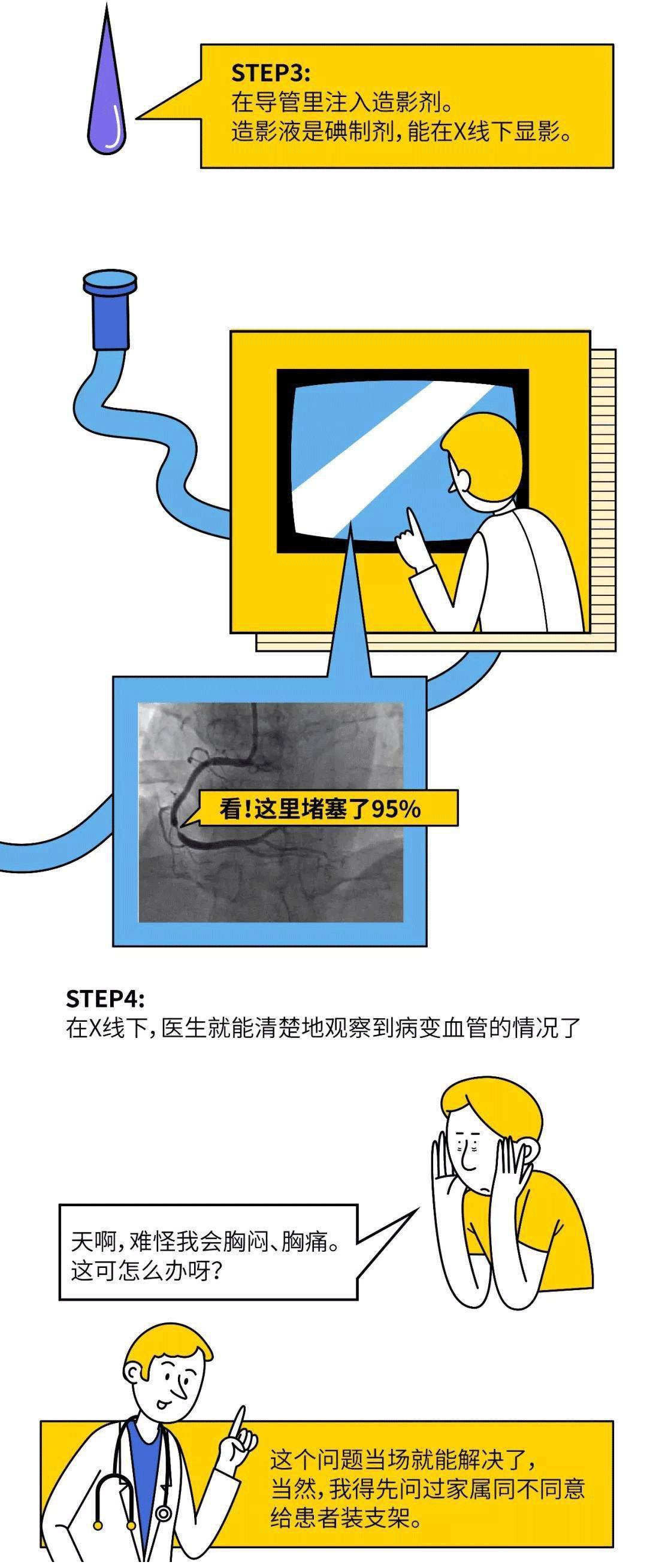 漫畫圖解丨心臟支架是怎麼裝進去的?