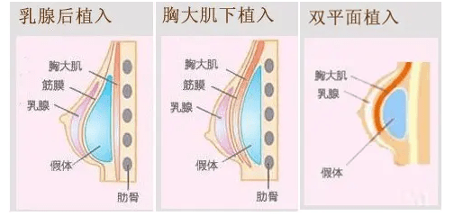 更精准术前,医生会以患者乳房大小和体型决定胸大肌离断范围和水平.