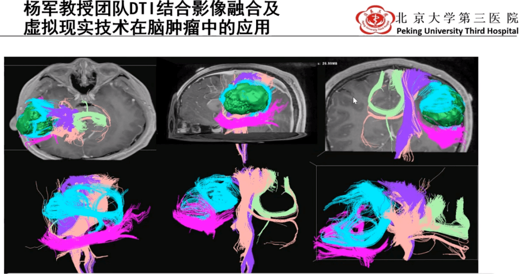是将dti结合影像融合技术及虚拟现实三维成像技术应用于神经外科临床