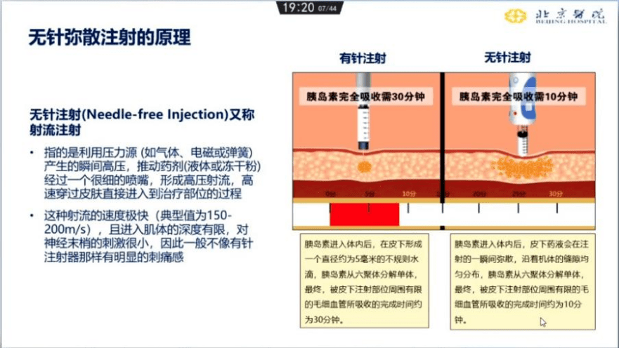 了无针注射器与glargine笔皮下注射甘精胰岛素对胰岛素使用量的影响