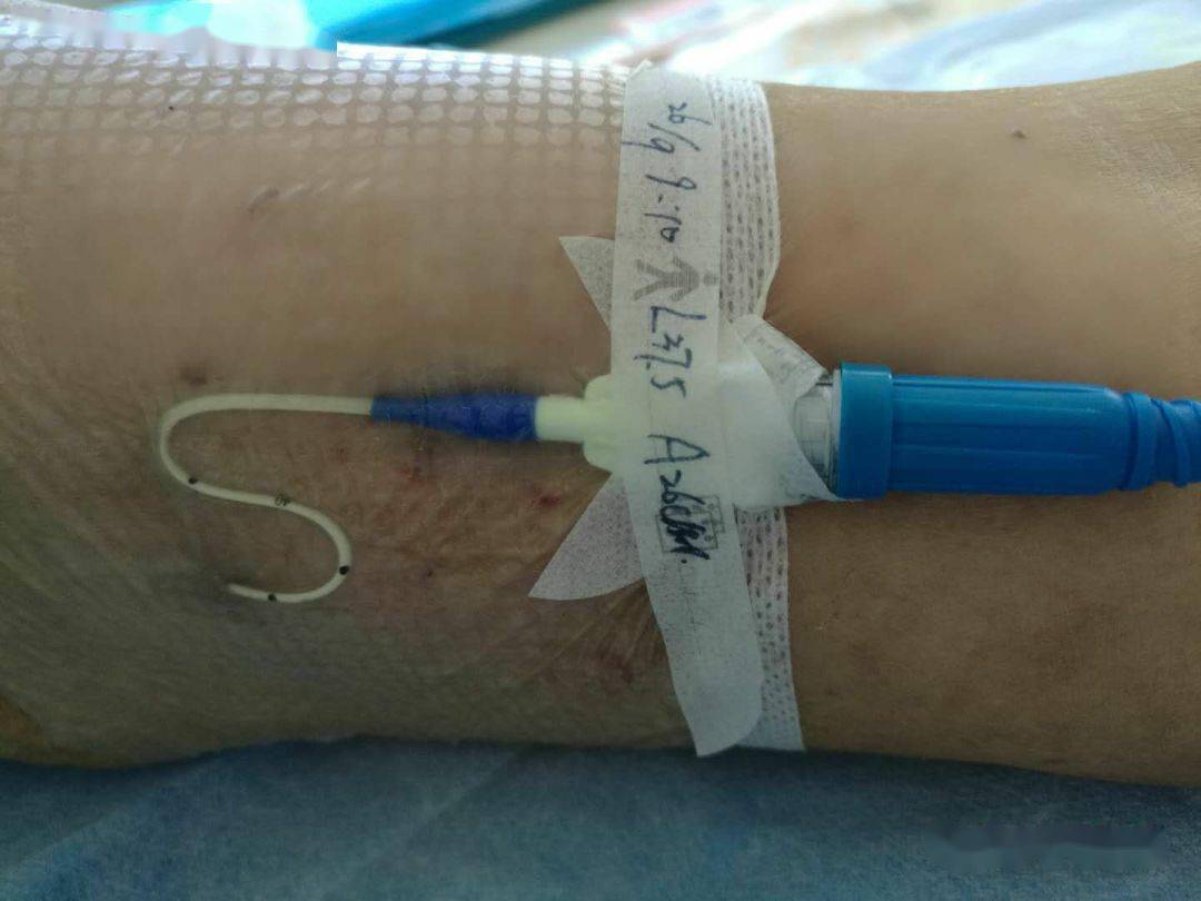 如何正确固定picc导管外露部分