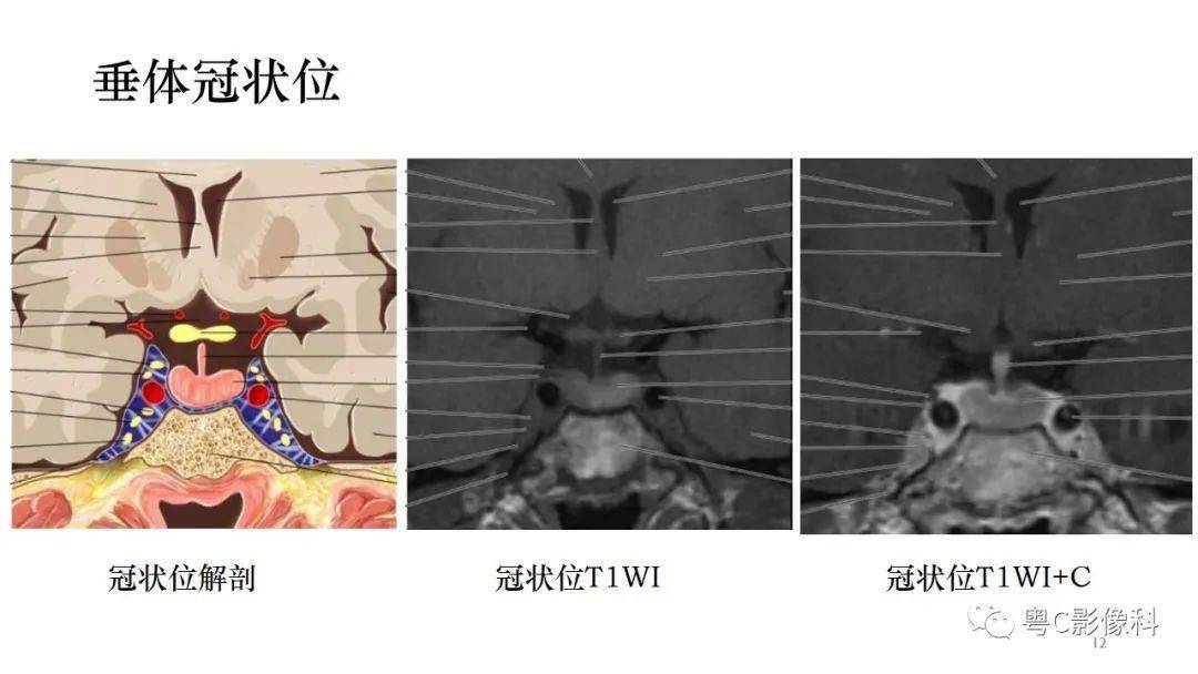 从垂体发育到垂体病变讲清楚了