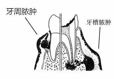 2,牙周脓肿:也就是这个包是牙周炎导致的脓肿,一般还伴有深牙周袋,袋