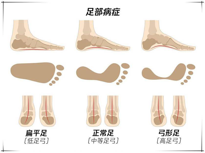 影响宝宝的脚型和腿型之所以叫足弓,是因为正常情况下人的脚底内侧