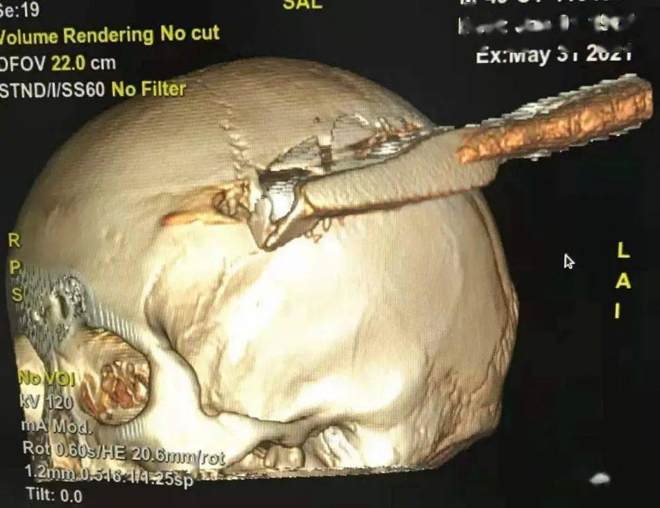 惊险惠州一工地钢筋高空坠落直插工友头颅