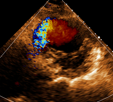 病例分享超声心动图诊断急性心肌梗死合并室间隔穿孔