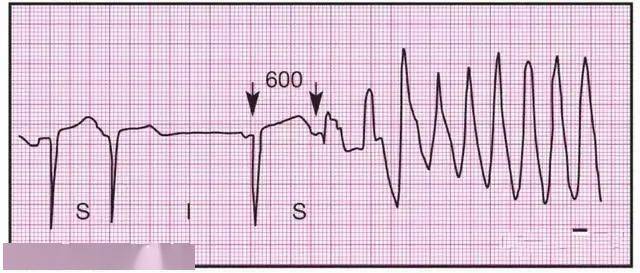 14种常见心电图波形的特点建议收藏