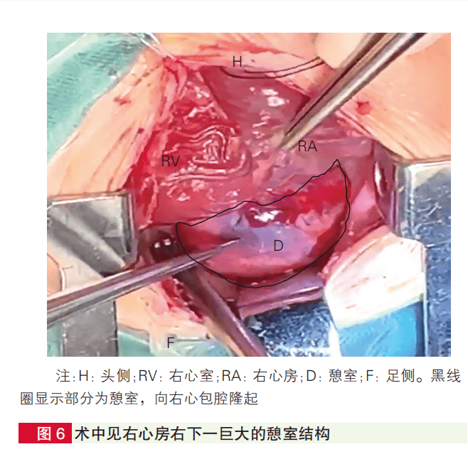 心脏超声误诊的罕见左心室憩室【浙大儿童医院病例】