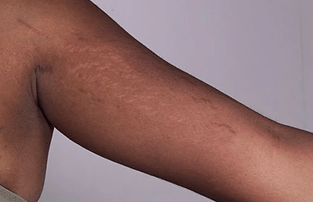 你的妊娠纹长在腰腿上还是胸臀上原来72的女性都会长这种纹