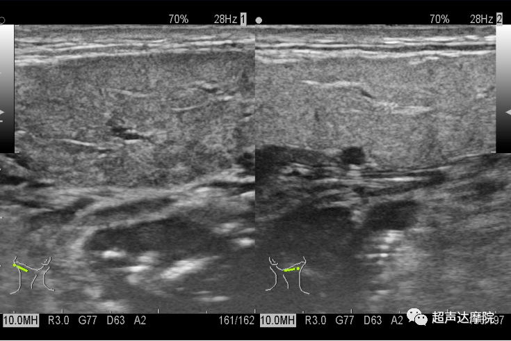 頜下腺導管結石的超聲診斷