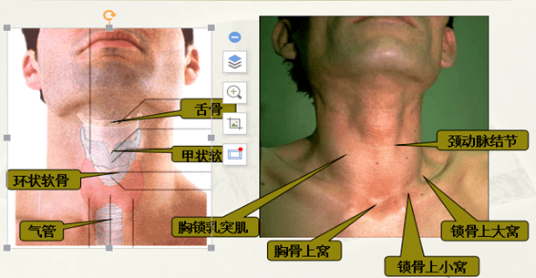 环甲膜穿刺的位置图示图片