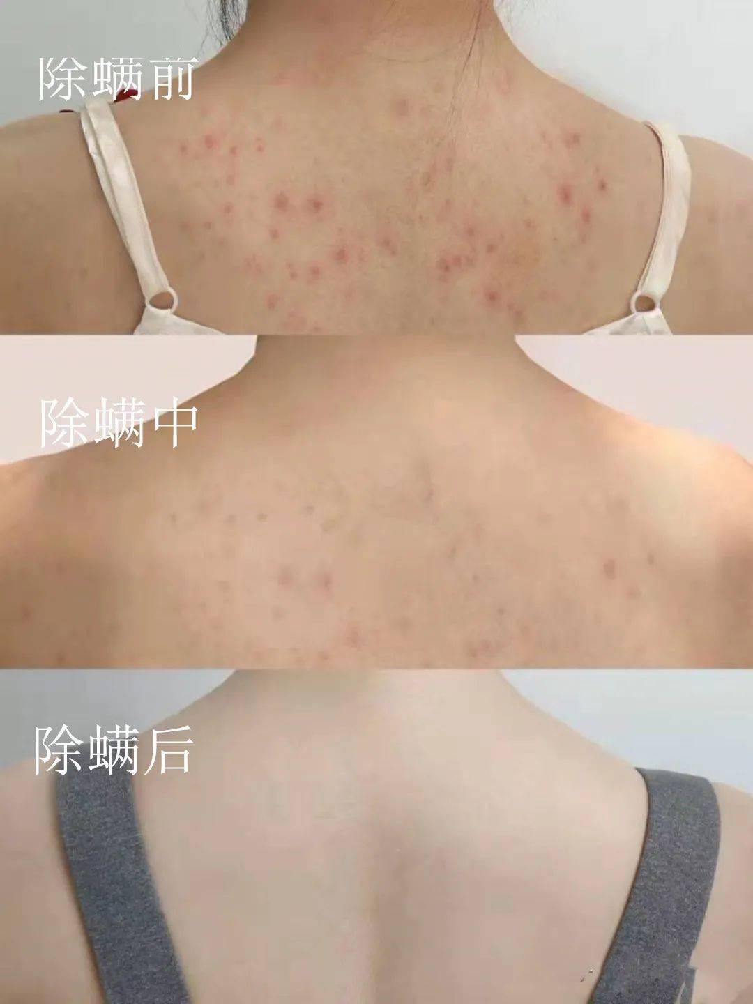 小殷,因为长螨虫痘,后背的毛孔非常粗糙,也就两瓶沐浴油,原本粗到能