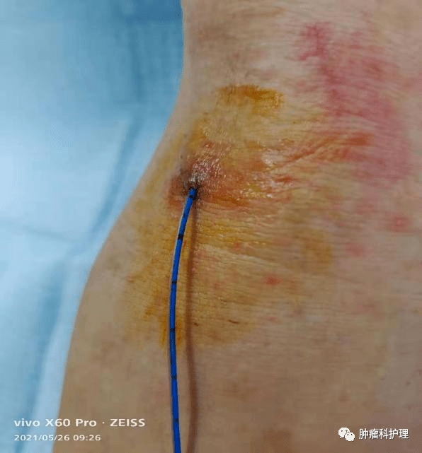 picc导管重度脱出该如何处理?