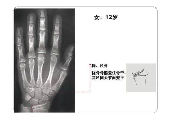 收藏必备丨骨龄图谱(修正版)_骨骼