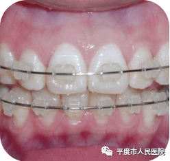 怎样能让牙齿变成平牙齿 03f99b205c69419d90bf547624cff7c0.png