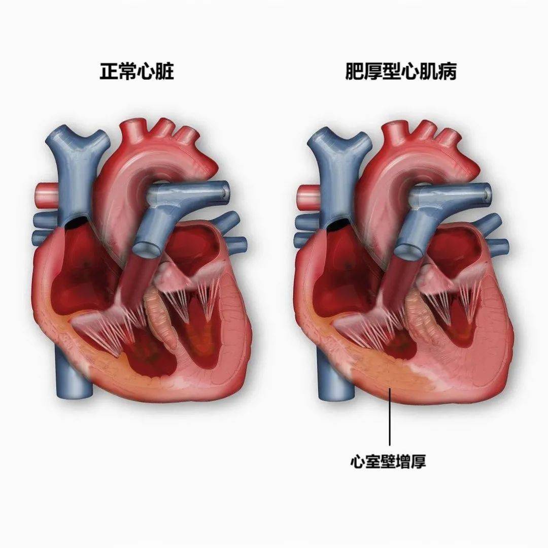 肥厚型心肌病