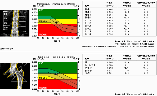 我连续吃了七年的钙片,为何骨密度还在直线下降?