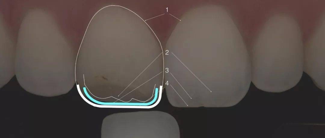 【病例分享】中切牙的修复:复合树脂直接修复vs全瓷贴面修复