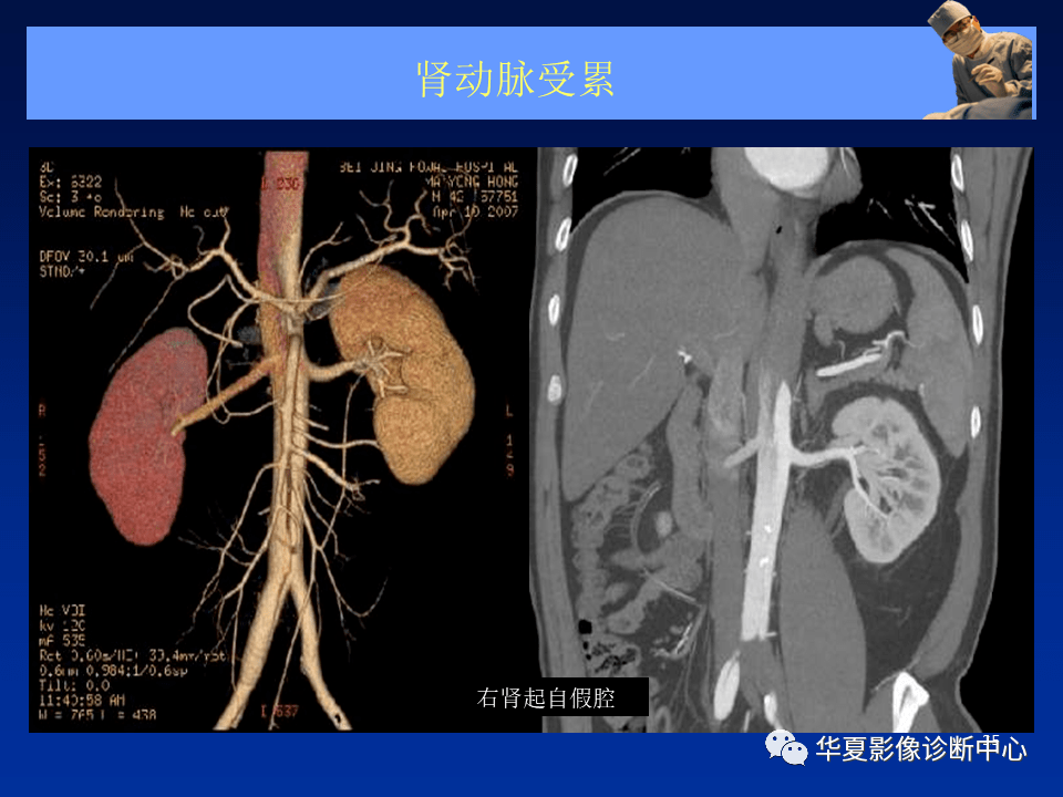 主動脈夾層,壁間血腫及穿通性潰瘍