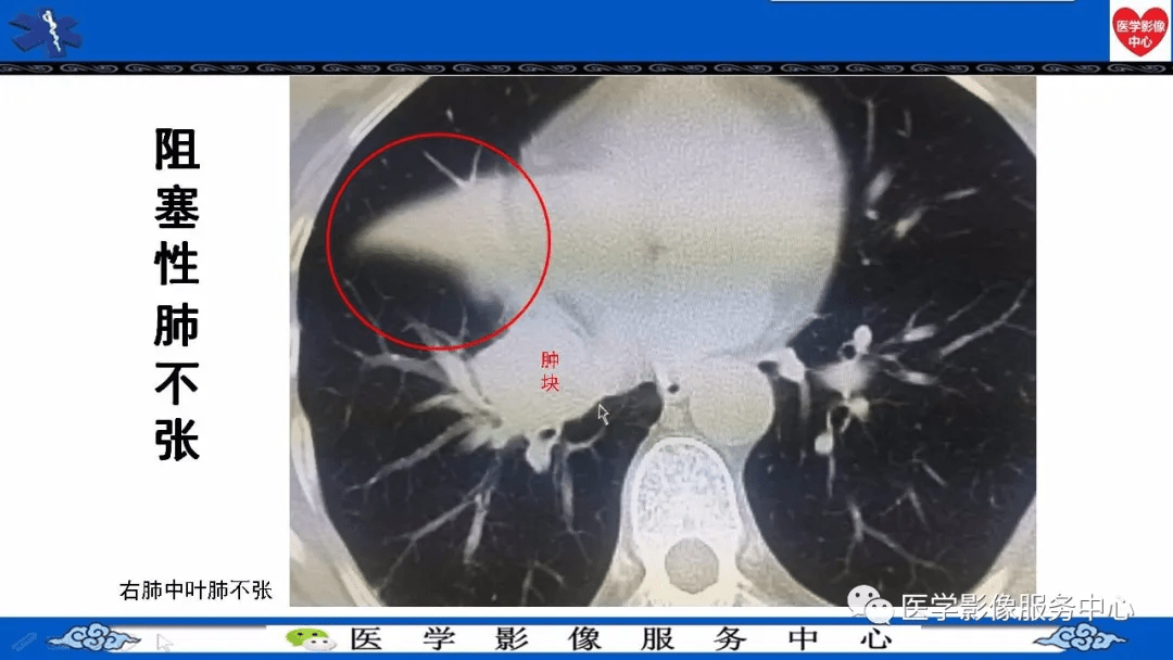 基础学习中央型肺癌典型征象