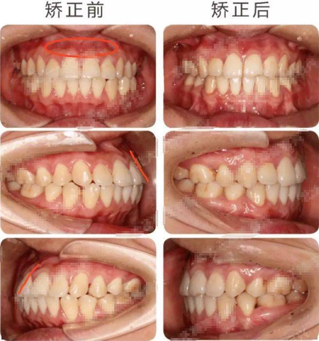 牙性vs 骨性,你的变美潜力有多大?