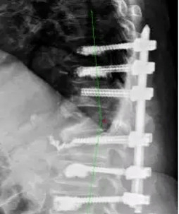 多节段腰椎间盘突出可以微创吗 b9ed100c06b94509a4d4159e13a4fba0.png