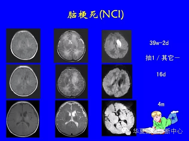 最全新生儿颅脑mri诊断工作必备大家看过来