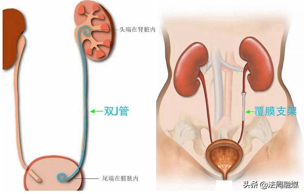 输尿管dj管图片