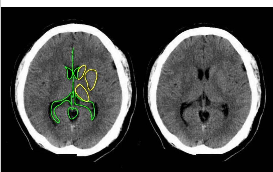 特征性异常脑影像荟萃95绘重置版ct篇