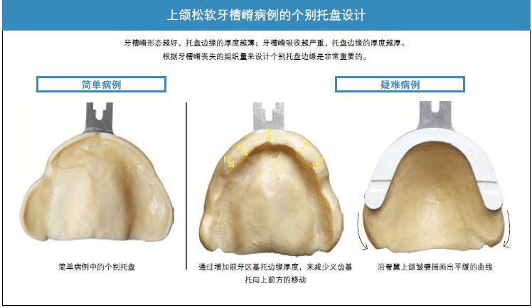 特點3:高級版書籍增加了針對嚴重舌後退,重度骨吸收,鬆軟牙槽嵴患者的