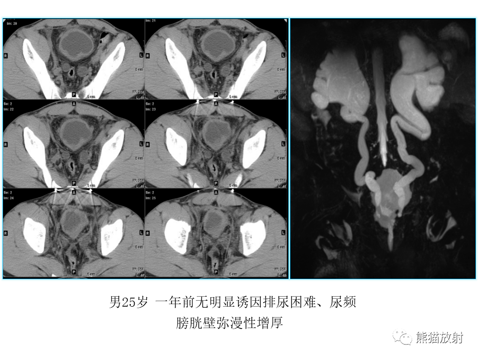 放射性膀胱炎图片图片