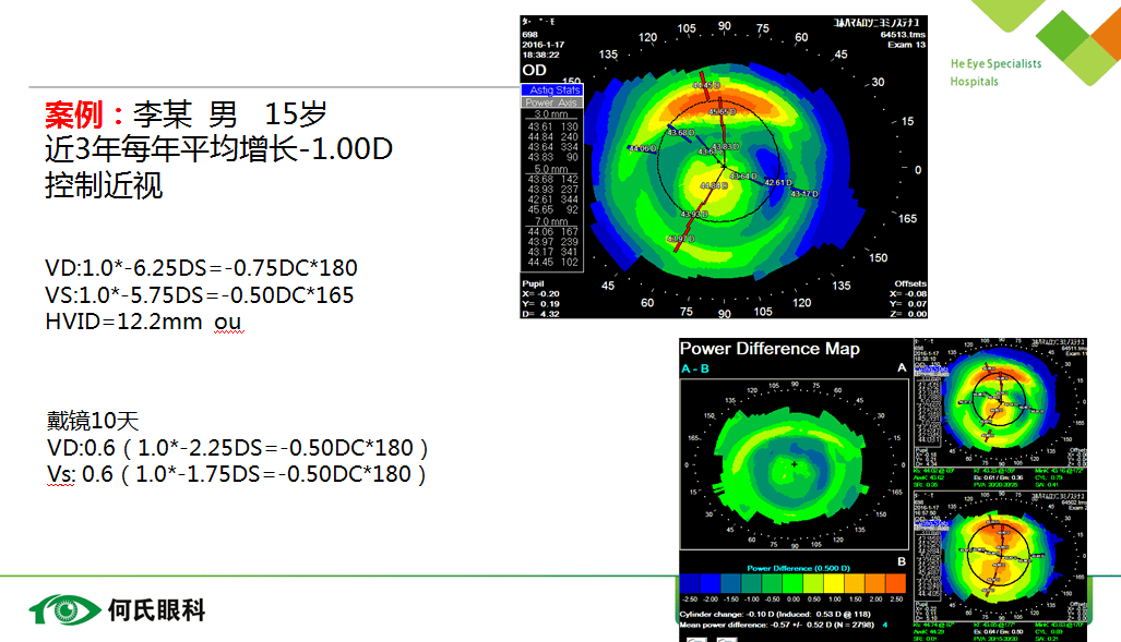 eyehealthdoctor關愛視覺健康,呵護心靈之窗角膜地形圖在塑形鏡中的