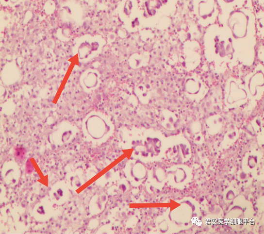 经he染色后,血管丰富,核染色质深染,细胞成腺管样,腺泡样(如箭头所指)
