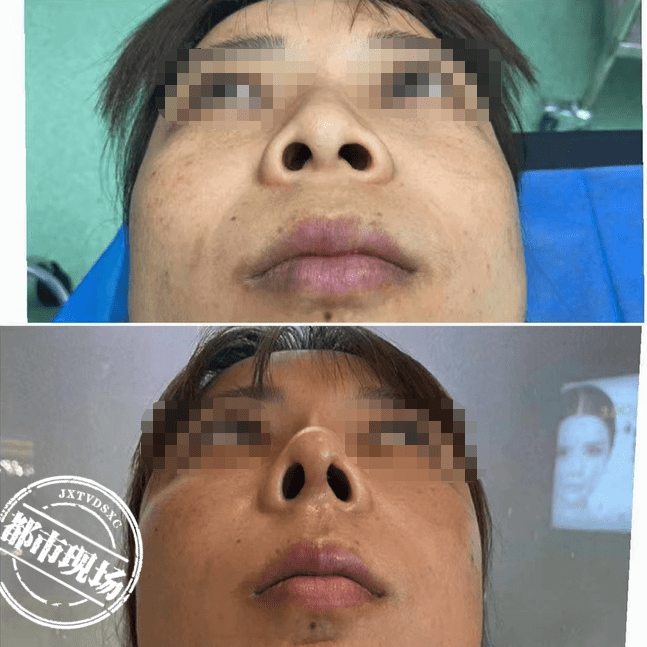 黄女士:很不好看嘛,然后看着也有点恐怖,不敢出门,害怕人家看我,本来
