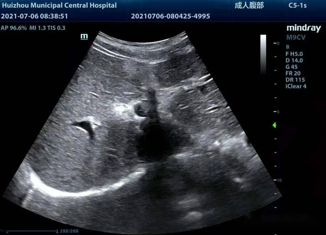 典型图片61sappey静脉_超声