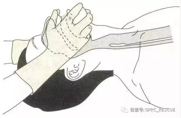 另一只手食指和中指放置下颏骨部向上抬颌,使下颌尖,耳垂连线与地面