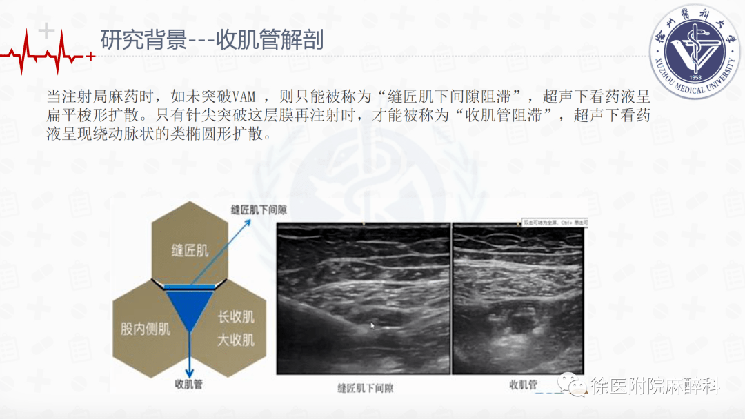 全膝关节置换术中局部浸润麻醉和连续收肌管阻滞结合ipack神经阻滞的