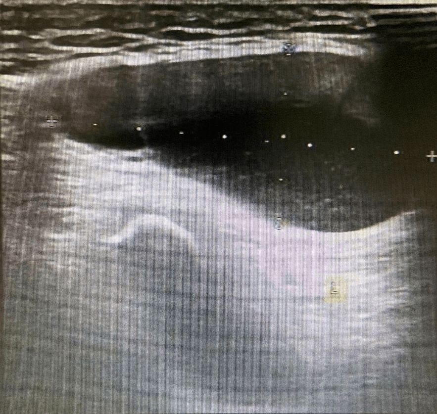 女性腹股沟处的包块,除了疝气,还可能是什么呢?