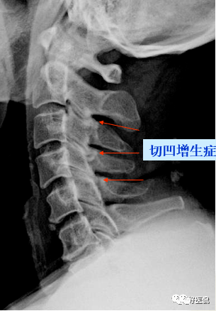 颈椎病解剖经典影像