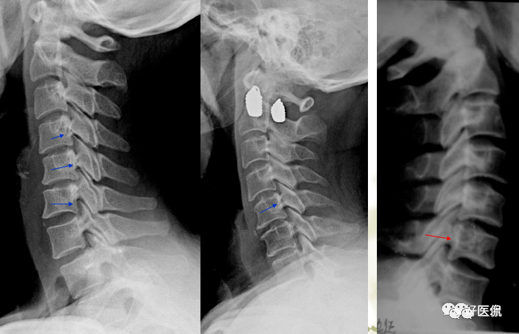 椎体旋转所致双边征双侧椎弓根形状不对称,钩椎关节间隙及椎弓关节