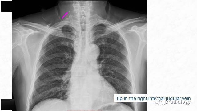 picc尖端的胸片定位_影像