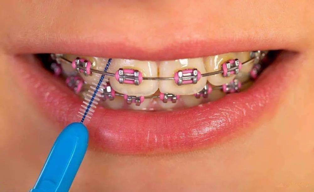 固定矯治器(fixed orthodontic appliances)是治療牙齒咬合不正