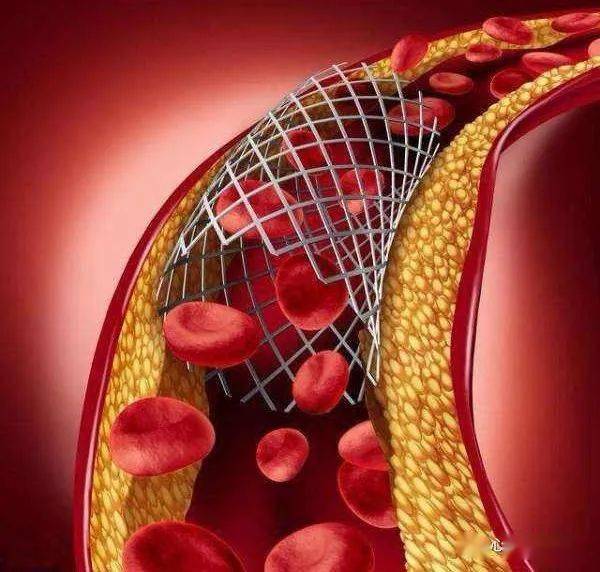一,冠心病支架:心脏血管狭窄到一定程度就会引起心绞痛,完全堵塞就是