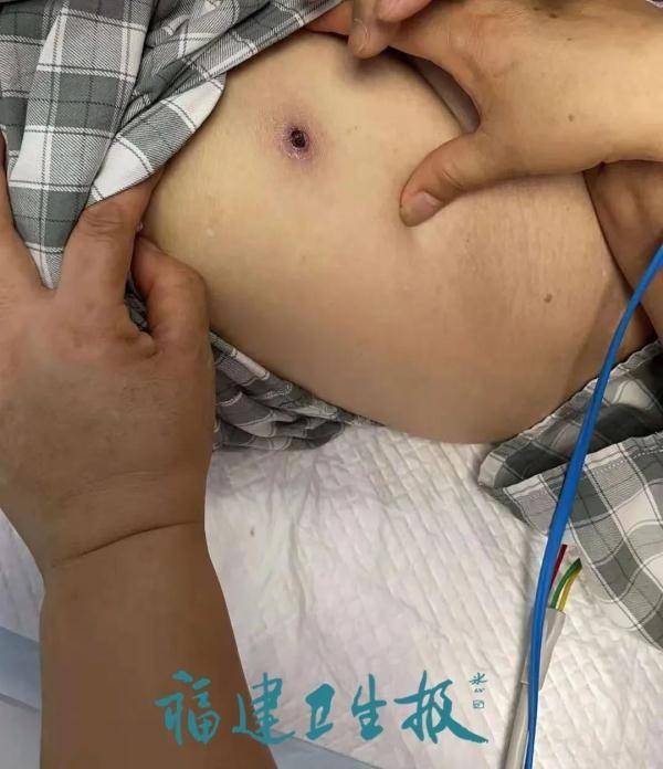 虫子|福州男子莫名发热咳嗽，竟是因这虫子…