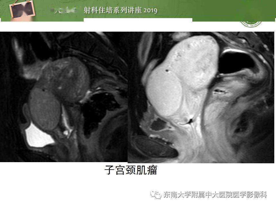 子宮詳細解剖及磁共振信號分析