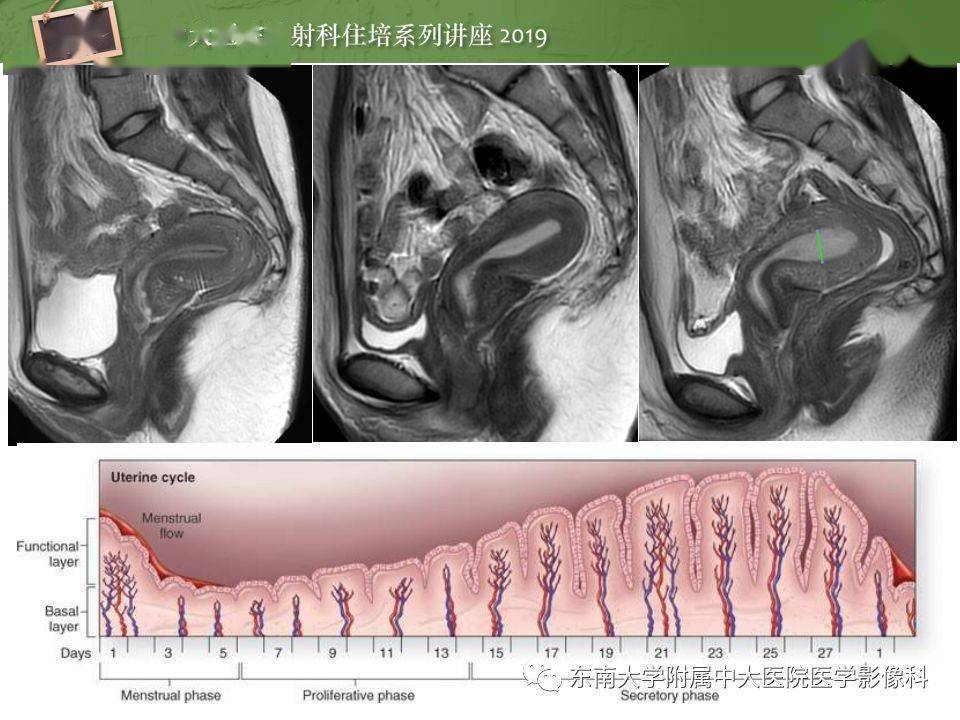 子宫MR解剖图片