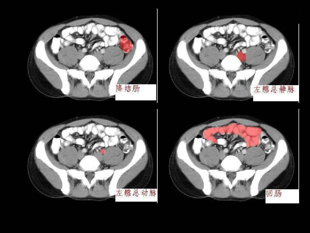 超細的腹部ct應用入門必備手冊(原理 精美解剖圖譜)